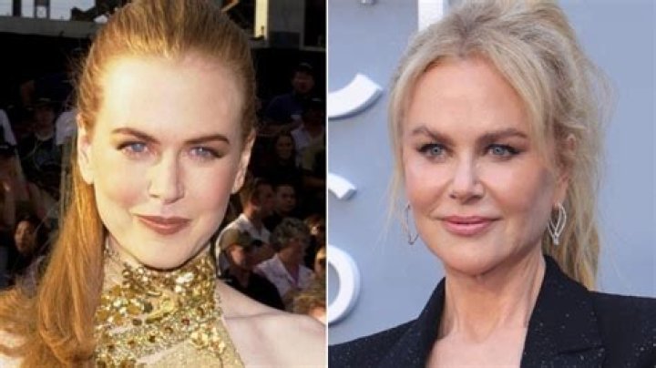 Unveiling the Truth: Nicole Kidman and Her Plastic Surgery Journey